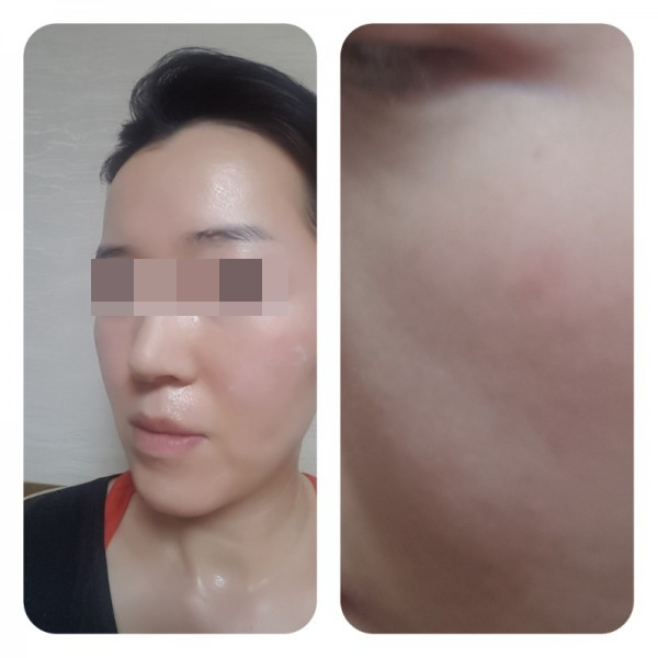  얼굴열감 얼굴따가움 소양증 로션 사용후기