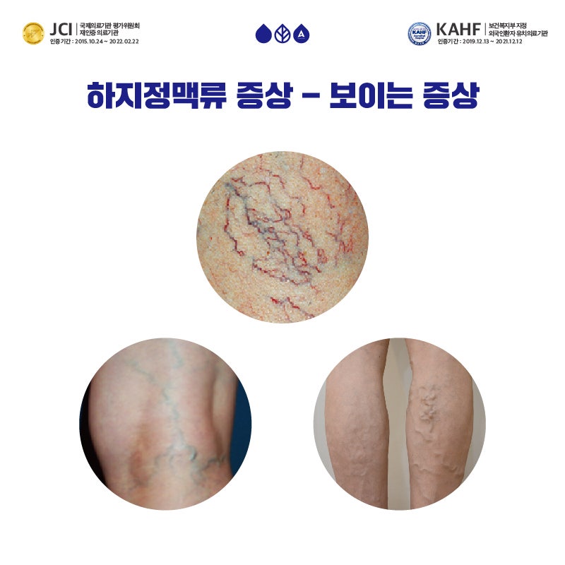 하지정맥류 원인 과거와 다른 부분은 명의와 함께 알아보세요! 15