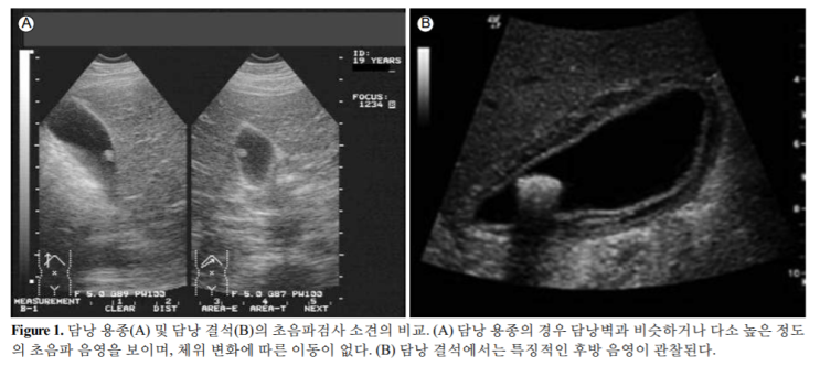  [건강검진 특집] 담낭용종