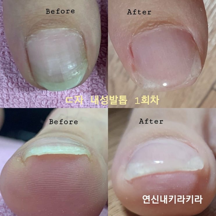  [ 발관리 ]은평구내성발톱 연신내내성발톱 무좀발톱 스켈링 빠르게 관리받으세요!!!