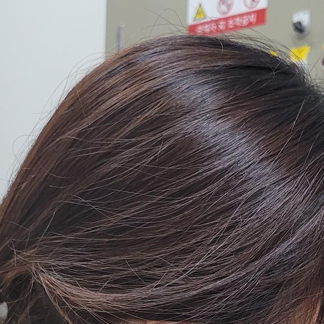  지루성두피염  16년째 나의생각!현재 거의완치?  홍보아니니 안심하고 들어오세용