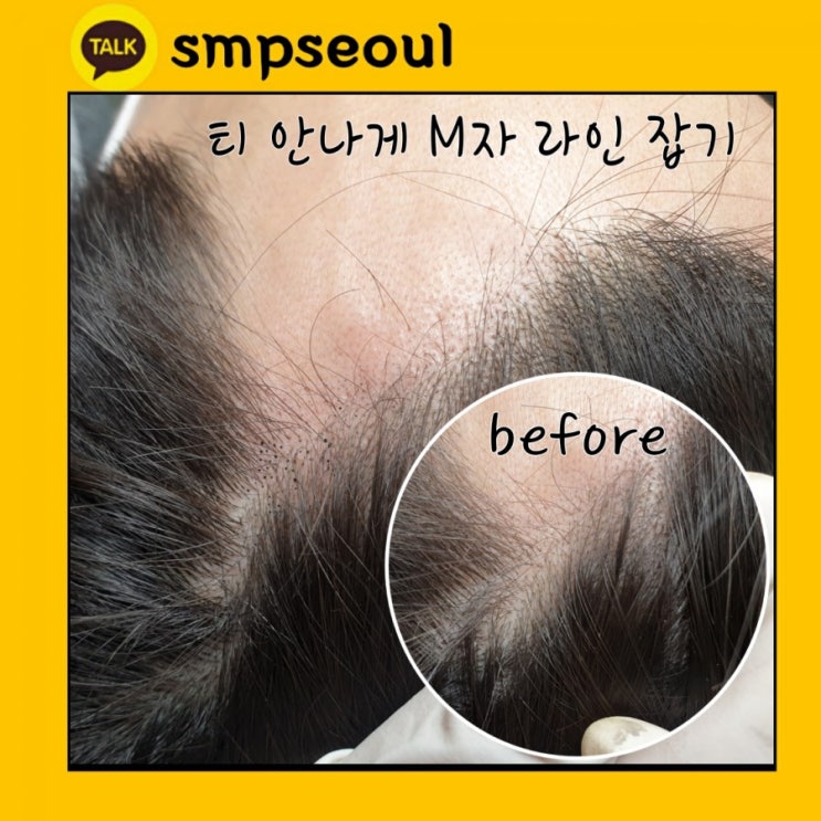  M자 탈모는 어떻게 커버할까요?