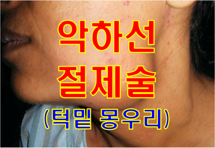  턱밑에 몽우리가 만져지는 50대 여자 - 악하선 절제술의 모든것