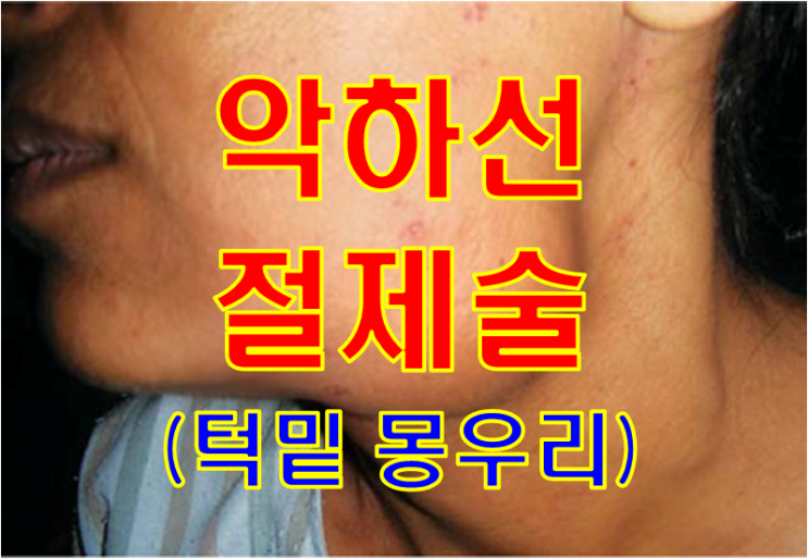 턱밑에 몽우리가 만져지는 50대 여자 - 악하선 절제술의 모든것