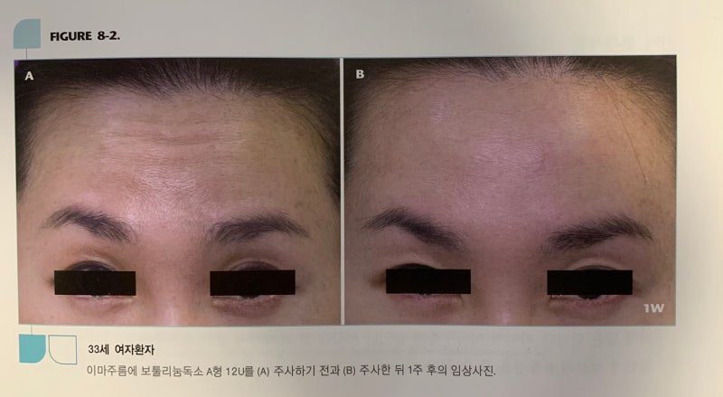 이마 보톡스 효과 시기는 언제쯤 보일까.
