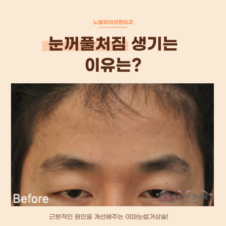  눈꺼풀처짐 생기는 이유는 미간근육 때문
