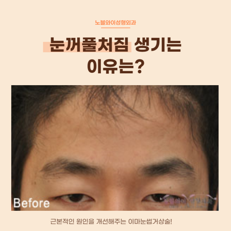 눈꺼풀처짐 생기는 이유는 미간근육 때문