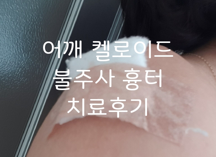  어깨켈로이드치료 불주사자국 켈로이드흉터 치료후기