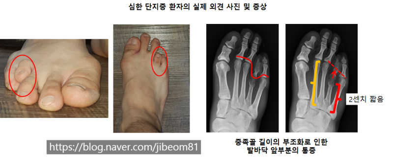심하게 짧은 네번째 발가락 단지증의 수술적 치료: 네번째 발가락이 너무 짧고 아파요! 발 앞부분이 아파요!: 짧은 외고정법후 ...