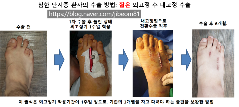 심하게 짧은 네번째 발가락 단지증의 수술적 치료: 네번째 발가락이 너무 짧고 아파요! 발 앞부분이 아파요!: 짧은 외고정법후 ...