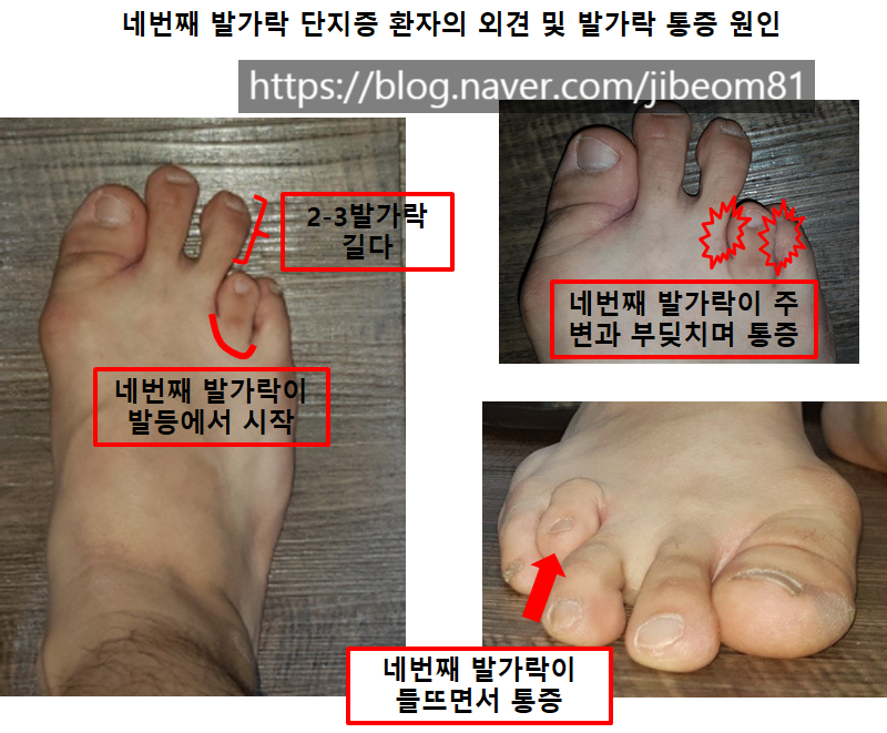 심하게 짧은 네번째 발가락 단지증의 수술적 치료: 네번째 발가락이 너무 짧고 아파요! 발 앞부분이 아파요!: 짧은 외고정법후 ...