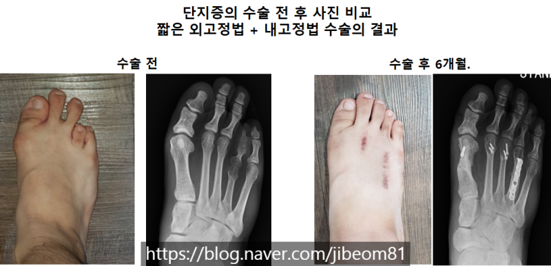 심하게 짧은 네번째 발가락 단지증의 수술적 치료: 네번째 발가락이 너무 짧고 아파요! 발 앞부분이 아파요!: 짧은 외고정법후 ...