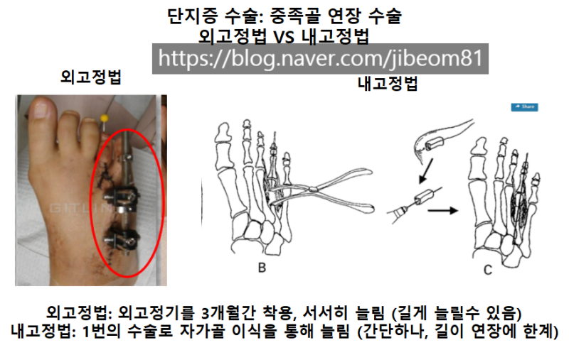 심하게 짧은 네번째 발가락 단지증의 수술적 치료: 네번째 발가락이 너무 짧고 아파요! 발 앞부분이 아파요!: 짧은 외고정법후 ...