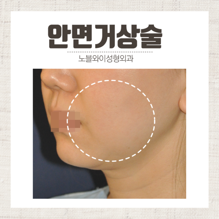  안면거상리프팅 흉터 때문에 걱정되나요