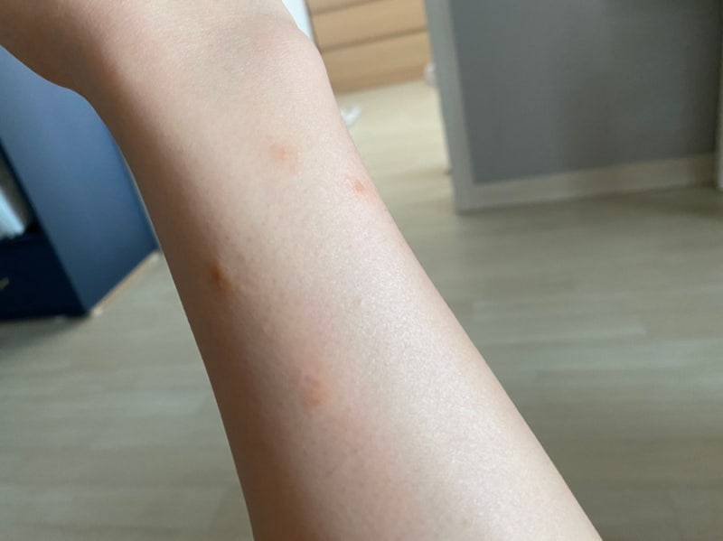 점빼고 듀오덤 알레르기인지 오래붙여서인지 여튼 점점 나아가는 상태 후기 : 네이버 블로그