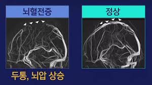  간호학 두개내압상승ICP 뇌관류압 원인진단 치료약물수술 간호중재케이스