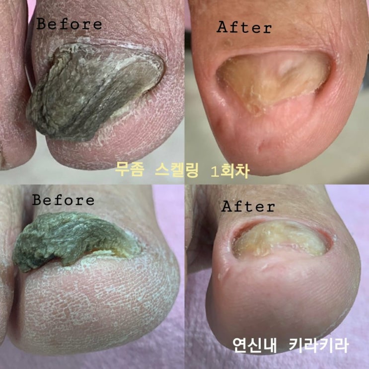  [은평구내성발톱]은평구무좀발톱, 은평구발톱교정은 키라키라