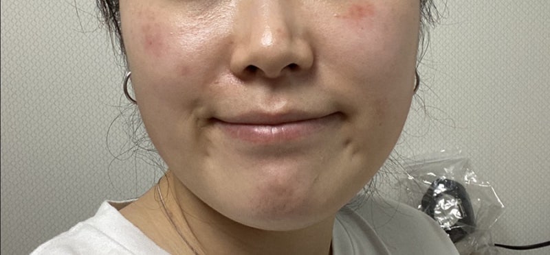 점빼고 듀오덤 알레르기인지 오래붙여서인지 여튼 점점 나아가는 상태 후기 : 네이버 블로그