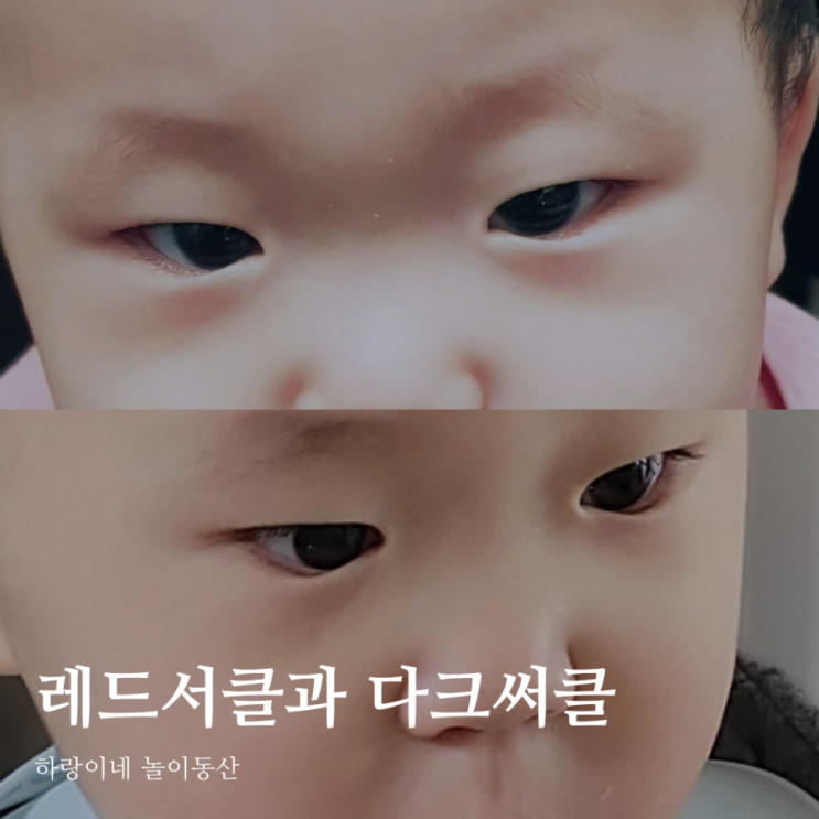  아기 다크써클과 유아 레드서클의 차이점?