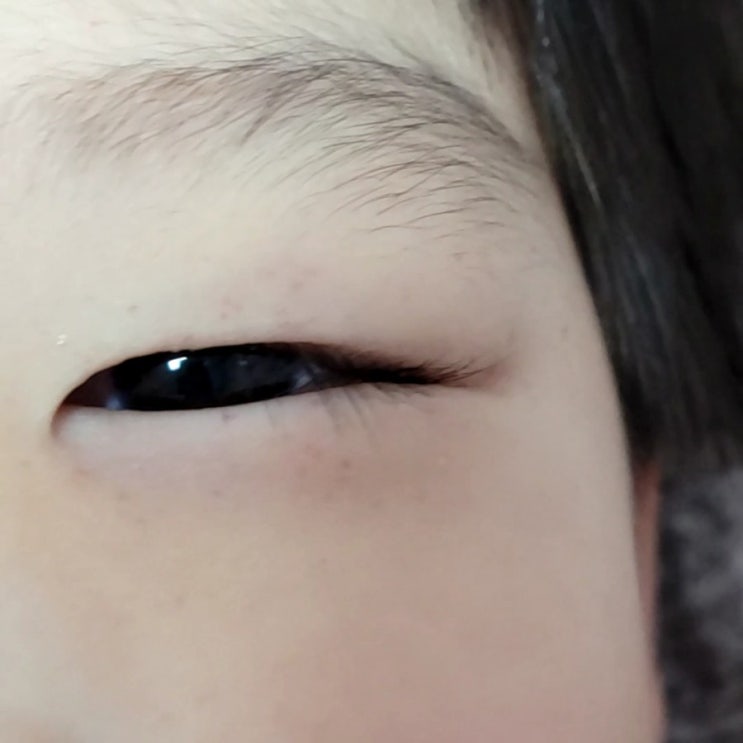  아이 눈꺼풀 붉은 점이 생기는 이유