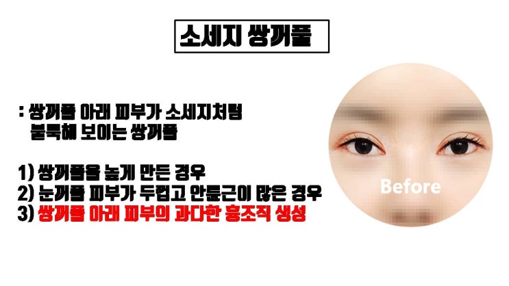  소세지 쌍꺼풀 교정하기 위해 절대 안륜근이나 흉살 제거하면 안 돼요. 더 큰 소시지 눈 돼요!!!