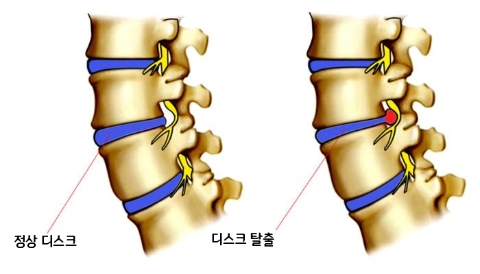 [이수역체형교정] 척추협착증 과 디스크의 차이 관련 편