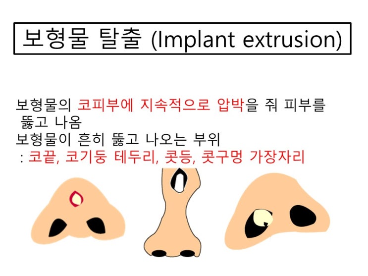  코수술 시 코실리콘 보형물 잘 못 넣으면 코끝으로 뚫고 나와요!!!