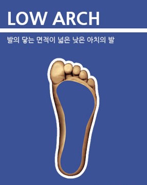 [대구맞춤깔창] 아치의 형태 평발(Low Arch)