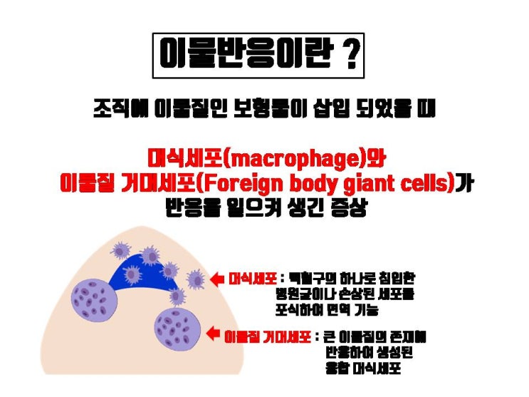  이물질인 코보형물, 코수술 후 염증을 일으키기도 하지만 이물반응을 발생시키기도 한답니다!!!