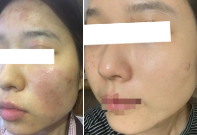  성인아토피증상에 사용한 로션 홈케어후기