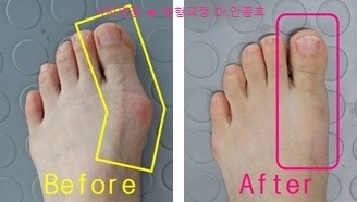  무지외반증 증상을 개선하기 위한 현명한 방법 