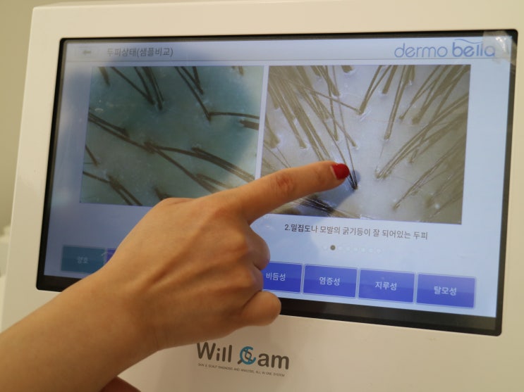  [잠실두피관리]송파 탈모관리는 SM뷰티에서!두피진단 및 케어