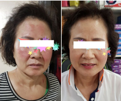  60대엄마의 알수없는 이유의 얼굴홍조 좋아진 이야기
