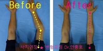  상완골골절 교정 수술후기