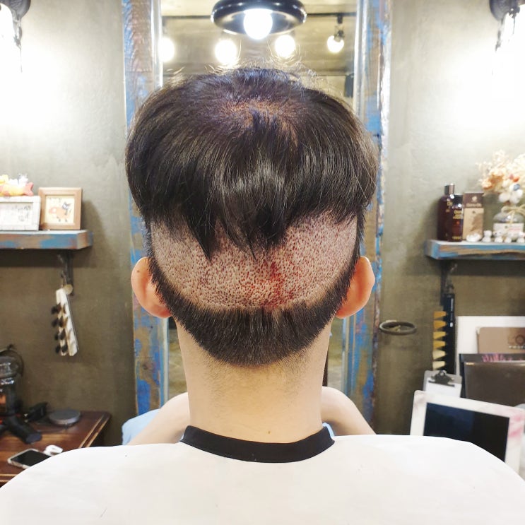  이마 머리심기 할 때 미리 체크할 것