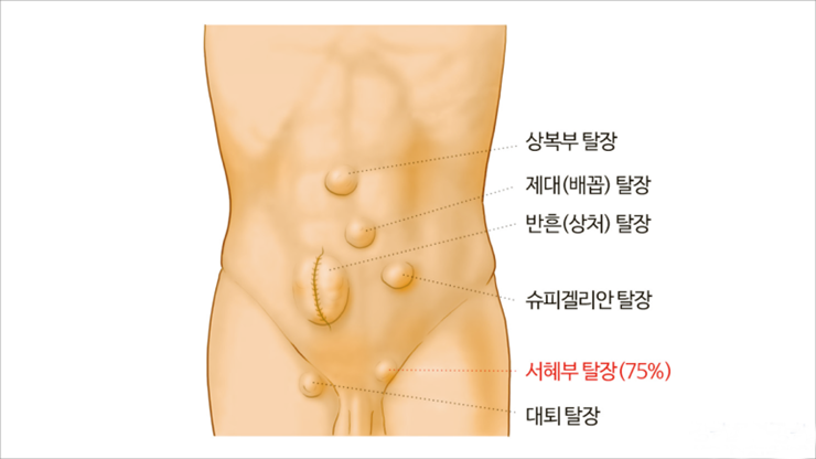 아이의 사타구니가 통통해요! 소아 탈장이란?