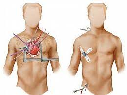 간호학 심장수술 대상자간호 약물교육 합병증 활력징후 정맥압 심잡음 수술전후