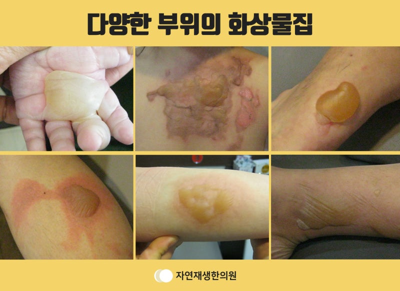 해운대화상치료 화상에 물집이 생기면 어떻게 해야 할까요? - 홀로가는 길