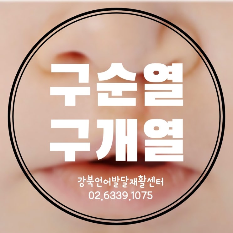  구순구개열 언어치료[구개열][구순열][보상보음]