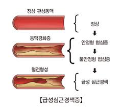 심근경색종류 원인증상 치료약물 인공심장수술교육순서 간호학케이스