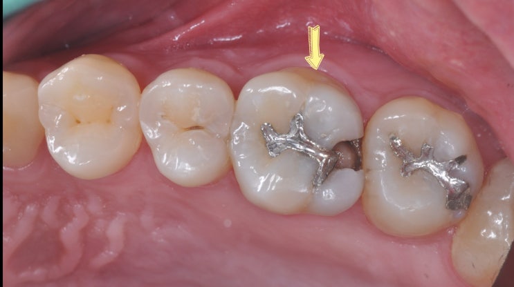치아 신경치료 과정 중 매우 중요한 레진월 만들기