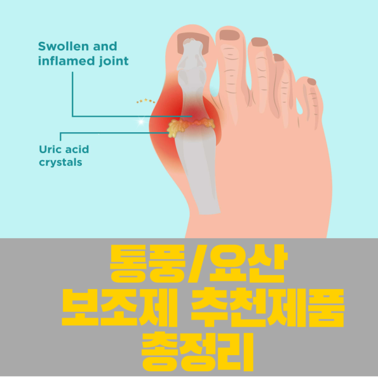  [아이허브]통풍 요산수치(고요산혈증) 보조제 영양제  추천 총정리!