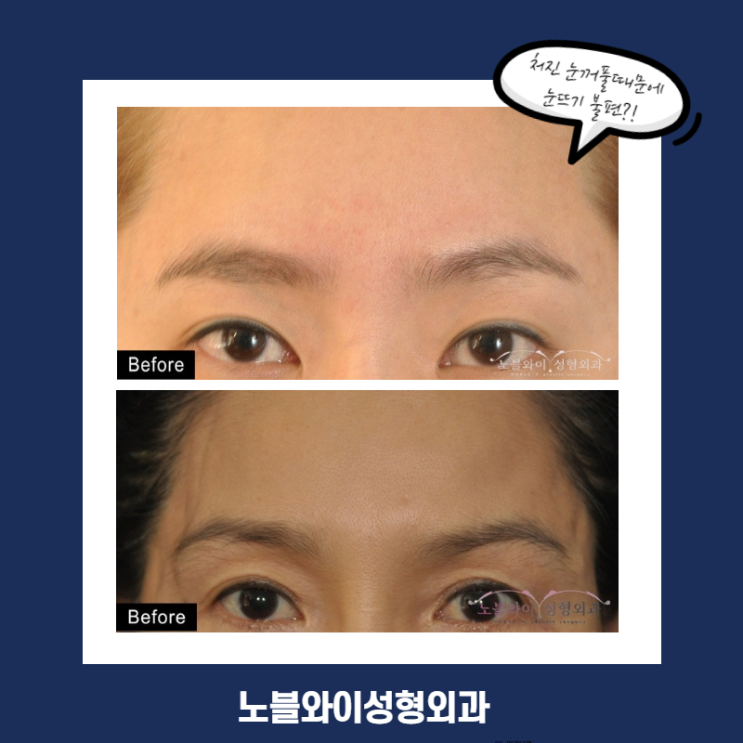  이마눈썹거상술비용 이렇게 효과가 다양한데 추가금없음