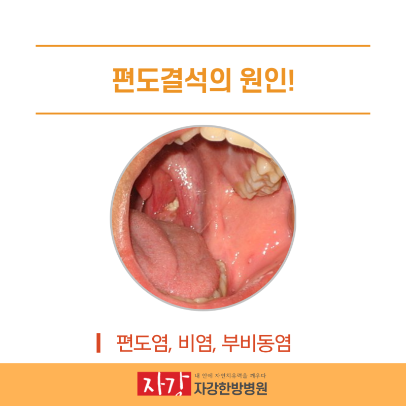 편도결석 제거 방법 : 양치질 방법