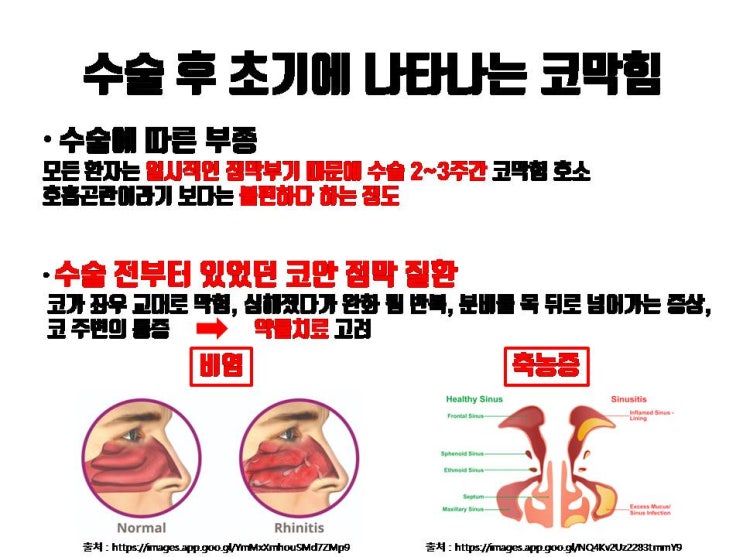  코수술 후 코막힘 증상 기간이 길어 지면 코수술이 원인일 수도 있어요!!!
