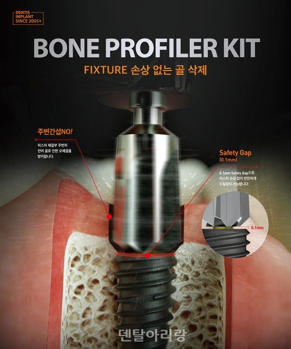 Bone profiler kit By Dentis (본 프로파일러 키트 by 덴티스) --> 일단 쓰지마세요 : 네이버 블로그