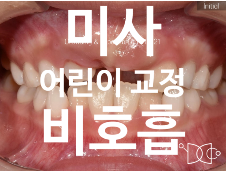 미사 어린이 교정이란? 구호흡 방지하고 코로 숨쉬기, 비염에 도움을 줄 수 있는 교정, 바른얼굴 만들기 프로젝트