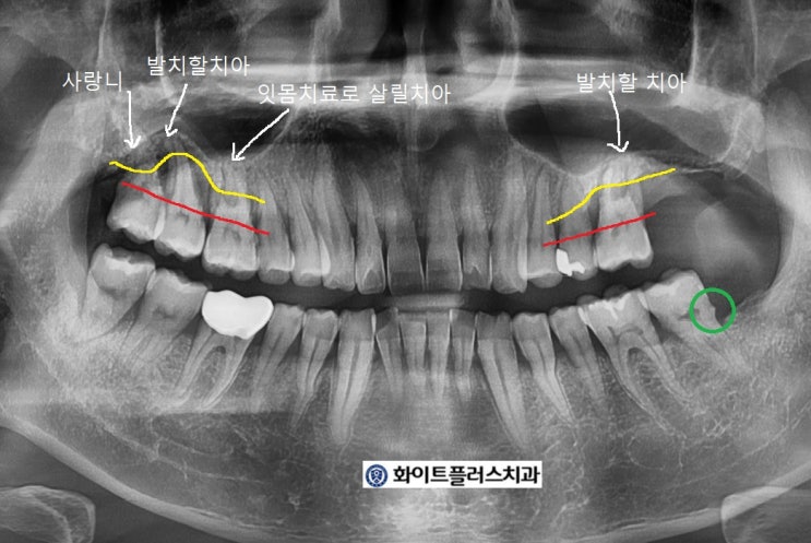  (신풍역 치과) 심한 치주염으로 상악동 임플란트 수술을 동반한 경우