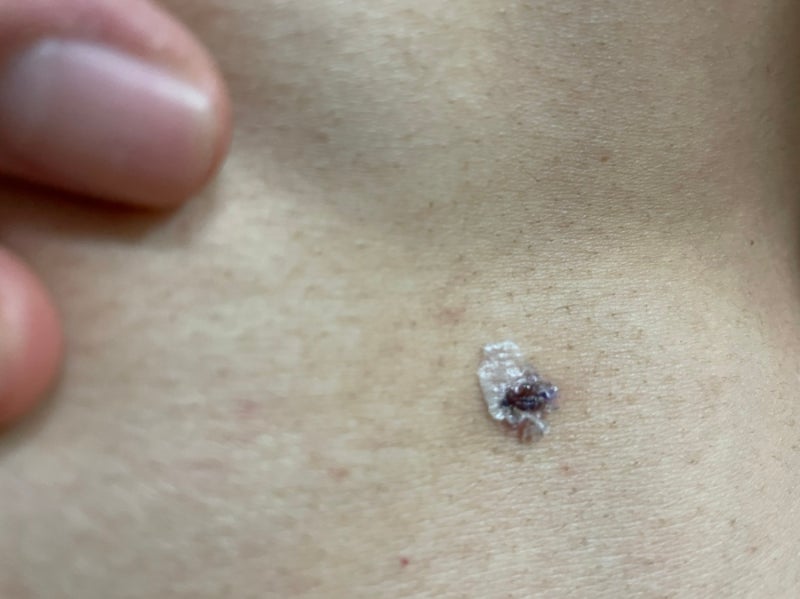 정계정맥류 수술 후기_일산병원