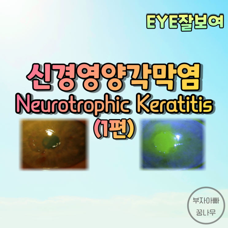 [EYE잘보여] 신경영양 각막염(Neurotrophic Keratitis), 신경영양 궤양(Neurotrophic Ulcer) (1) - 원인, 발생기전, 임상증상(임상양상)
